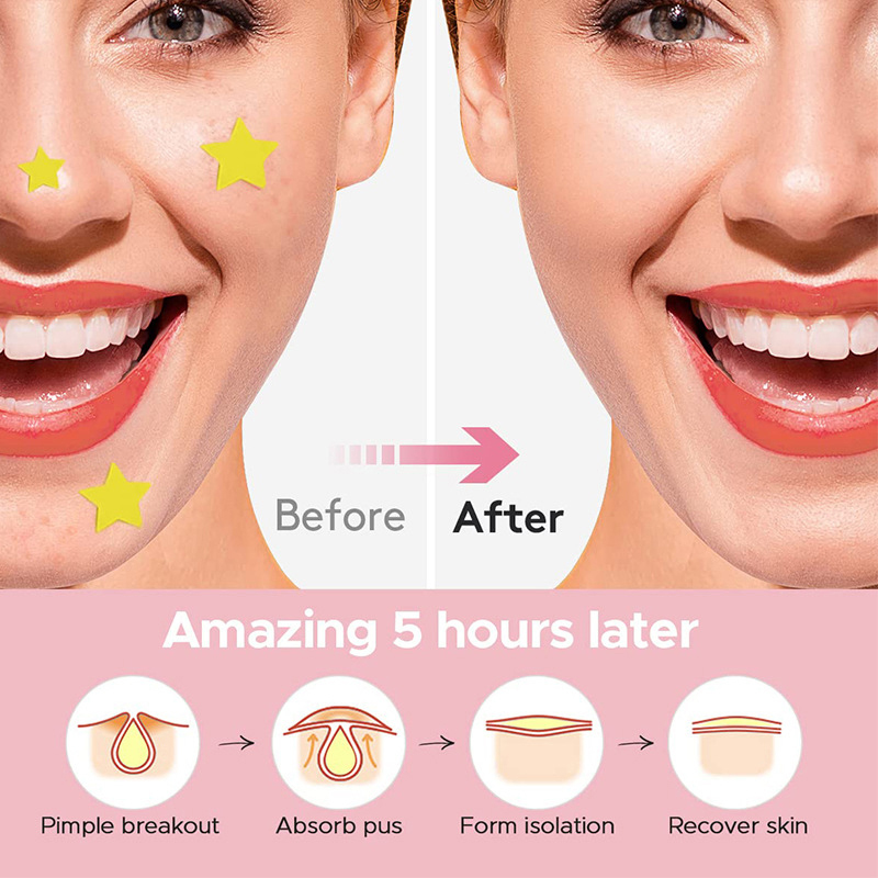 600 PCS/Set Star Pimple Patch  - Beauty Makeup Tool review and price
